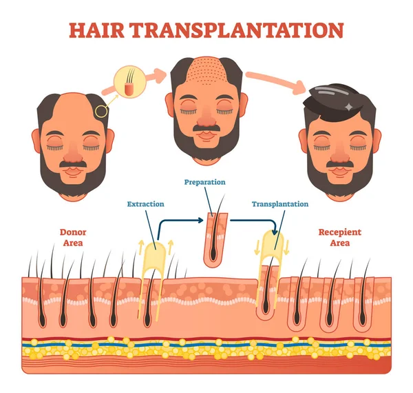 Diagrama del procedimiento de trasplante de cabello con pasos — Vector de stock