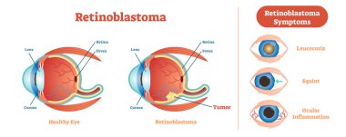 Retinoblastom vektör çizim diyagramı, anatomik düzeni. 
