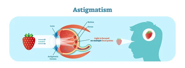 Astigmatismo diagrama de ilustração vetorial, esquema anatômico . —  Vetores de Stock