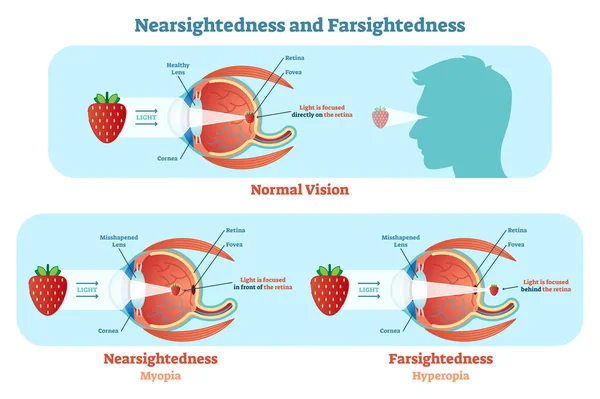 Far Sightedness and Near Sightedness diagrama ilustração vetorial, esquema anatômico . — Vetor de Stock