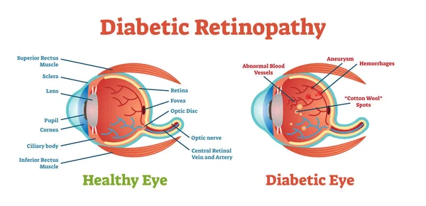 Diagrama da ilustração do vetor da Retinopatia Diabética, esquema anatômico . — Vetor de Stock