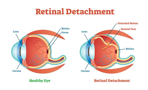 Retinal Detachment vector illustration diagram, anatomical scheme. — Stock Vector