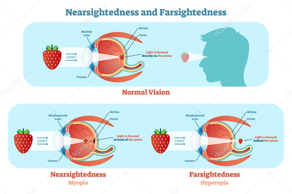 Far Sightedness and Near Sightedness vector illustration diagram, anatomical scheme. 