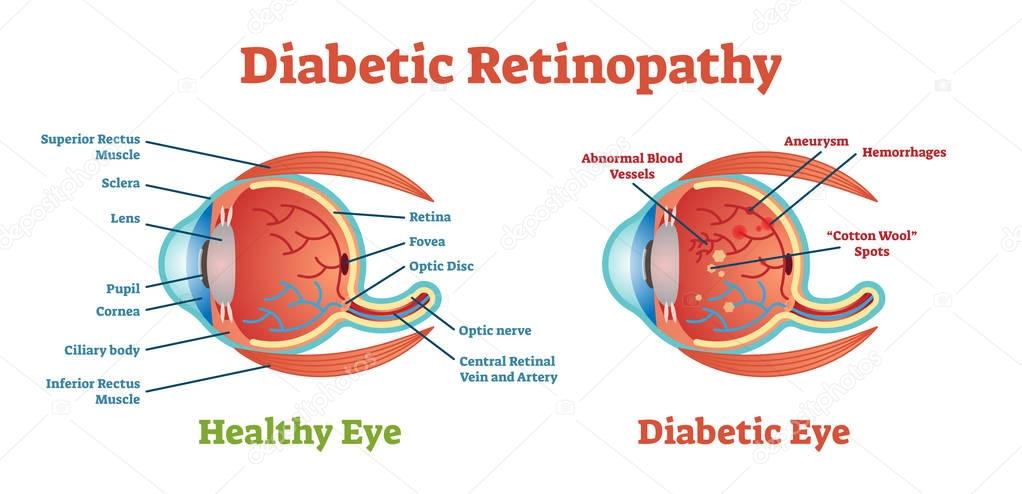 Diabetic Retinopathy vector illustration diagram, anatomical scheme. 
