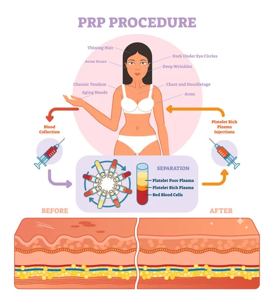 PRP Procedimento ilustração vetorial diagrama gráfico, esquema de procedimento de cosmetologia . —  Vetores de Stock