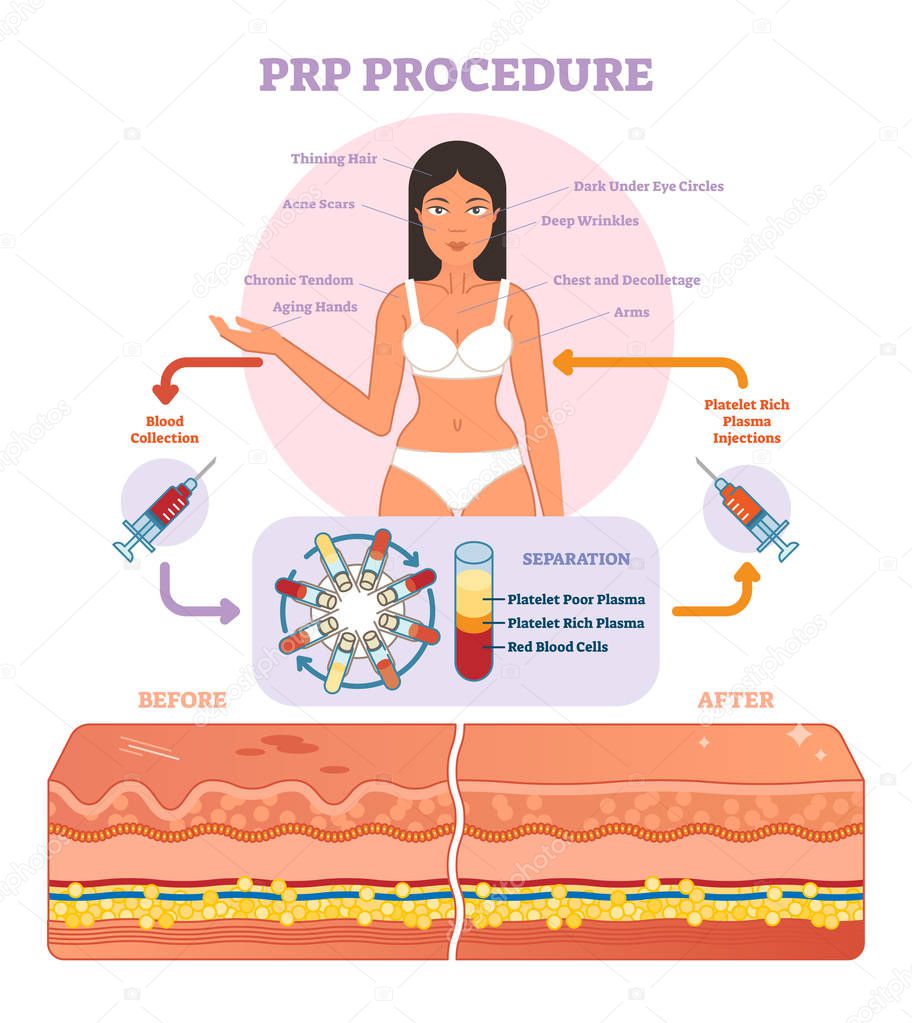 PRP Procedure vector illustration graphic diagram, cosmetology procedure scheme. 