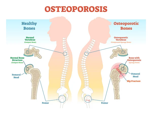 Exemplos de osteoporose diagrama de ilustração vetorial com densidade óssea . —  Vetores de Stock