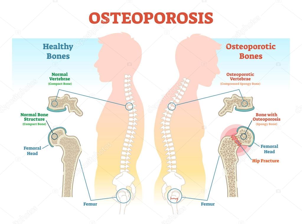 Osteoporosis System Disorder Template Osteoporosis System Disorder Template