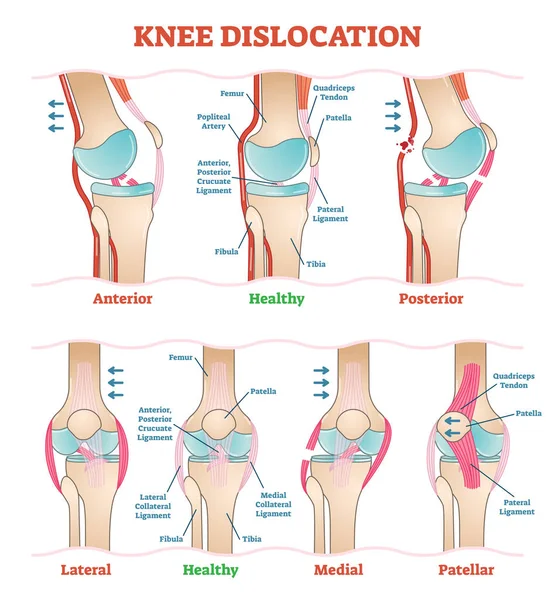 Knie dislocaties - medische vector illustratie diagrammen. Anatomische knie letsel typen regeling. — Stockvector