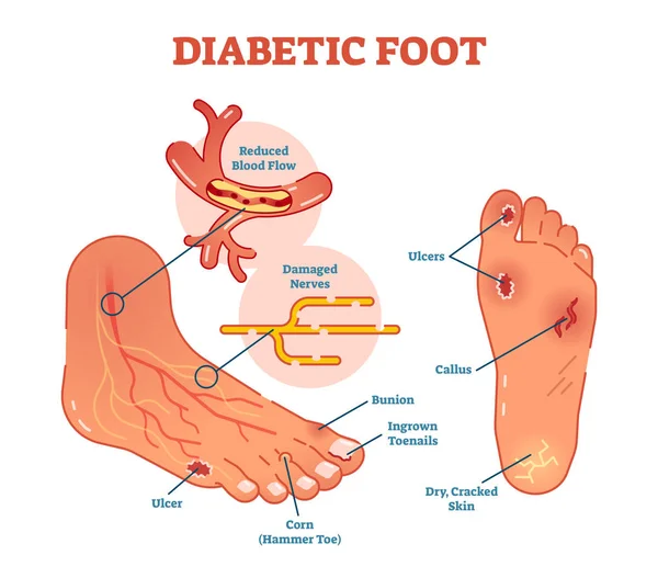 Pie diabético esquema de ilustración vector médico . — Vector de stock