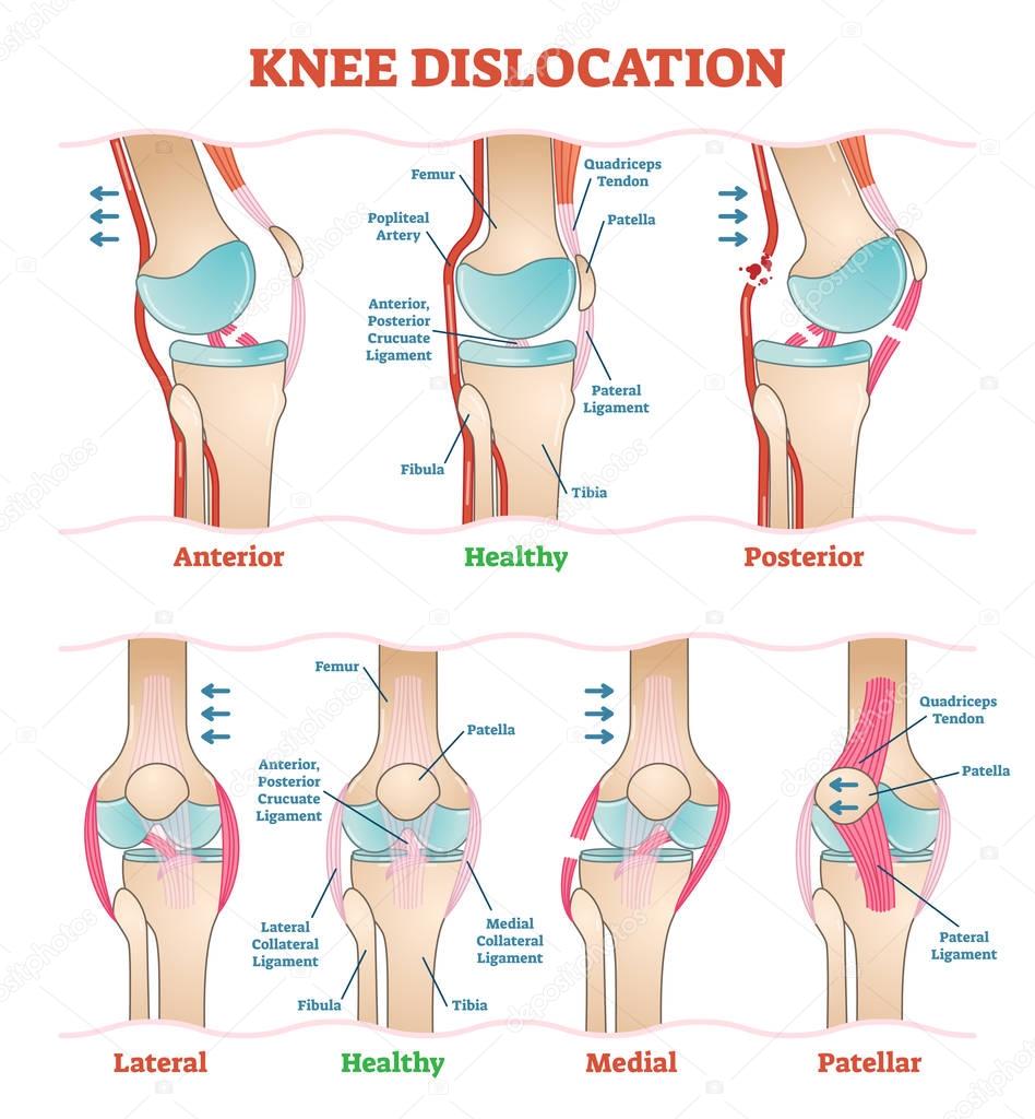Knee Dislocations - medical vector illustration diagrams. Anatomical knee injury types scheme. 