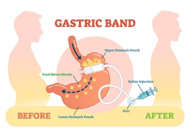 Gastrik Band anatomik vektör illüstrasyon diyagramı, tıbbi düzeni sonra önce.
