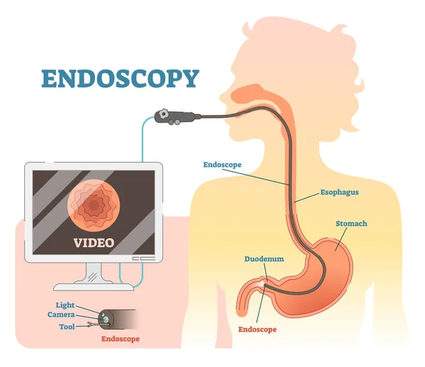 Diagrama anatômico da ilustração do vetor da endoscopia, esquema médico . — Vetor de Stock