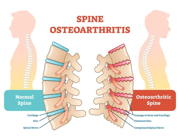 Diagrama anatômico da ilustração do vetor da osteoartrite da coluna —  Vetores de Stock