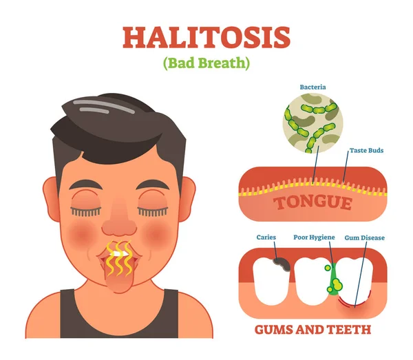 Halitosis. Slechte adem vector illustratie diagram poster. — Stockvector