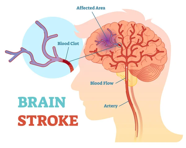 Cerebro accidente cerebrovascular vector anatómico diagrama de ilustración, esquema — Vector de stock