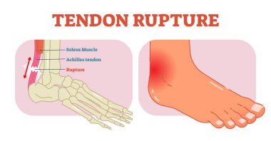 Tendon rüptürü anatomik örnek, vektör çizim diyagramı, eğitim sağlık scheme.