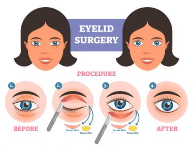 Eyelid surgery procedure before  after illuatration with main steps. Excess skin and fat removal. clipart