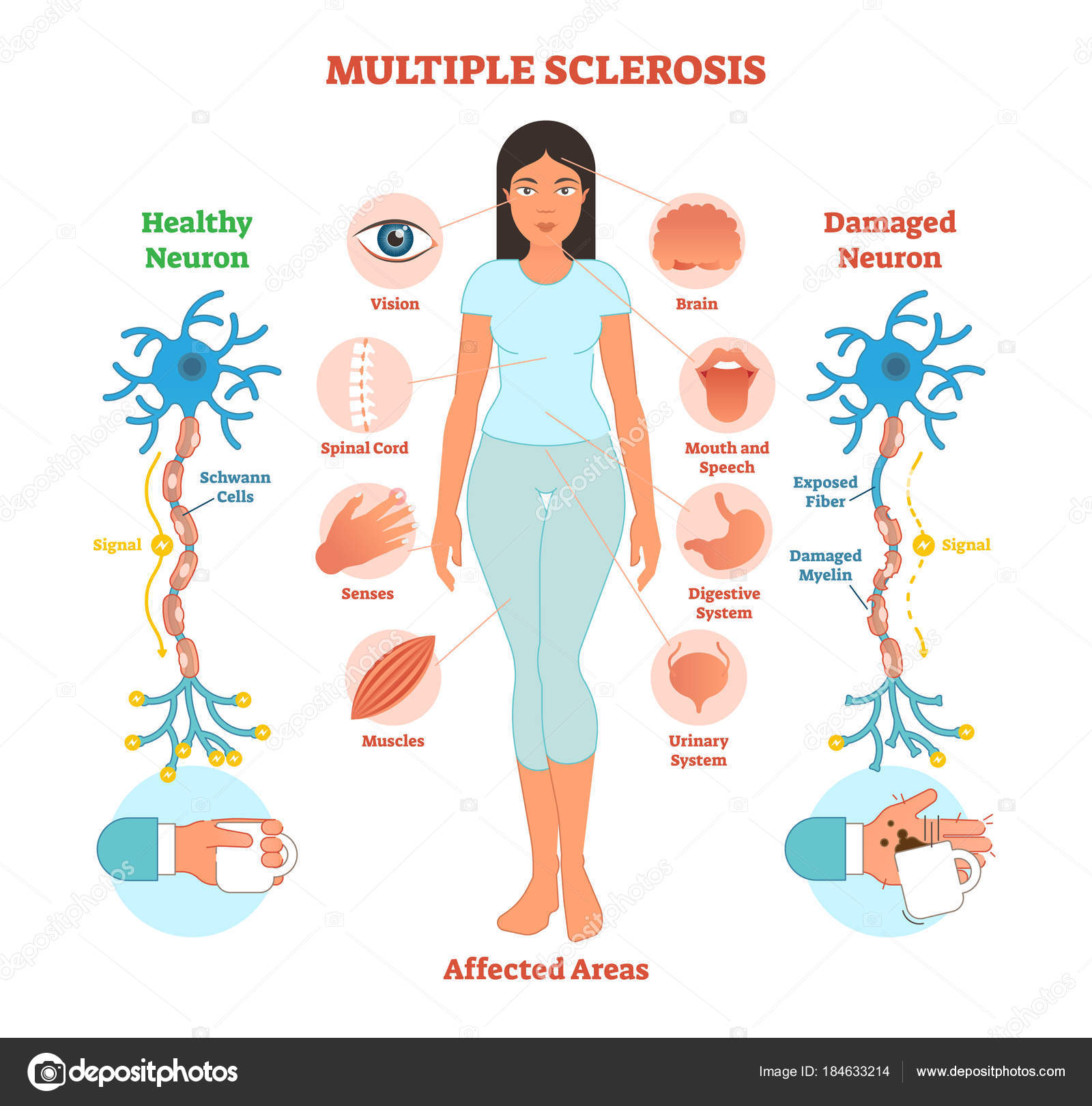 дебют рассеянного склероза симптомы. рассеянный склероз симптомы диагностика. рассеянный склероз симптомы и причины. первые симптомы склероза у женщин. рассеянный склероз.