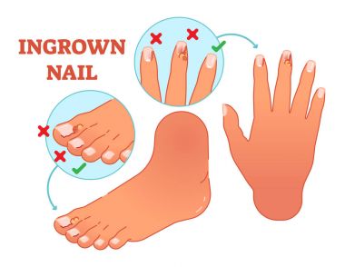 Ingrown nail medical vector illustration. clipart