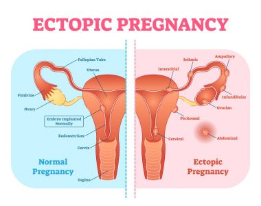Dış gebelik veya Tubal gebelik tıbbi diyagramı kadın üreme sistemi ve çeşitli embriyo ek konumları. 