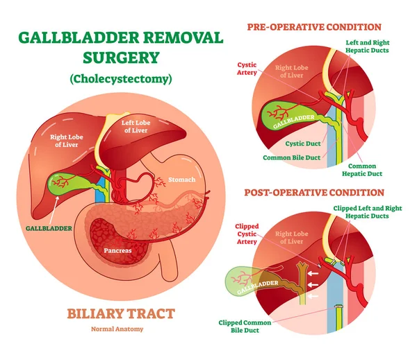 Cholecystectomy - gallblåsa borttagning kirurgi, anatomiska vektordiagram illustration med operativa villkor. — Stock vektor