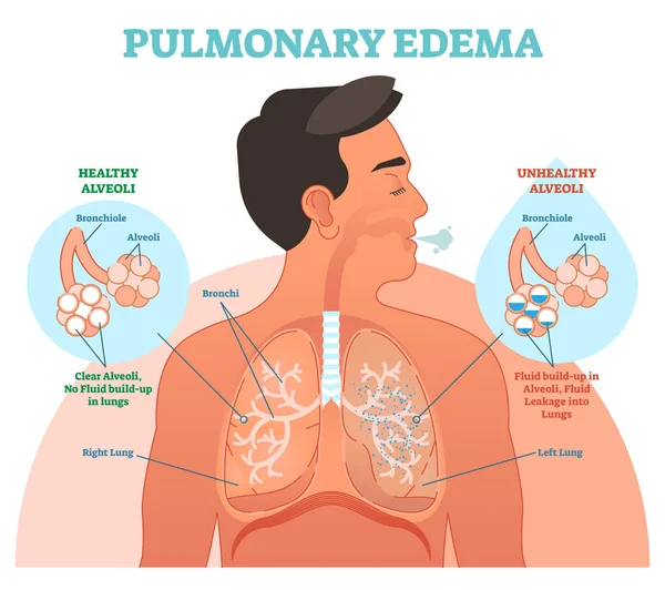 Πνευμονικό οίδημα, πνεύμονα πρόβλημα διανυσματικά εικονογράφηση διάγραμμα — Διανυσματικό Αρχείο