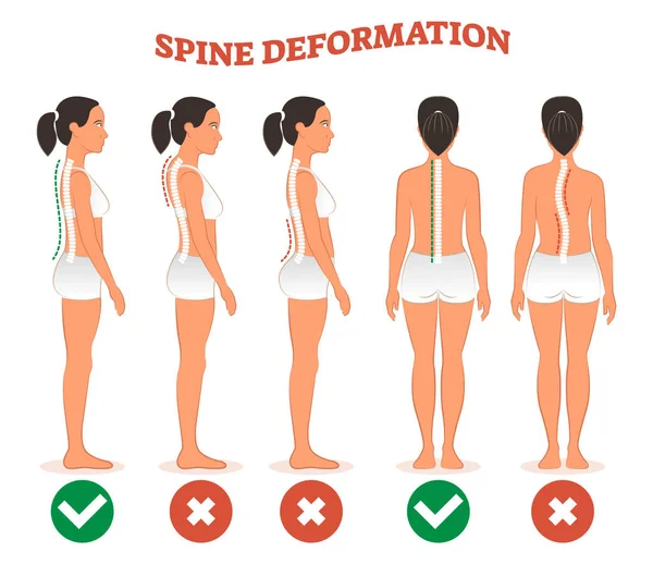 Types de déformation de la colonne vertébrale et affiche de diagramme de comparaison de colonne vertébrale saine . — Image vectorielle