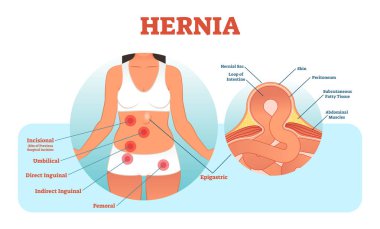 Hernia types vector illustration and cross section of muscle rupture and intestine. clipart