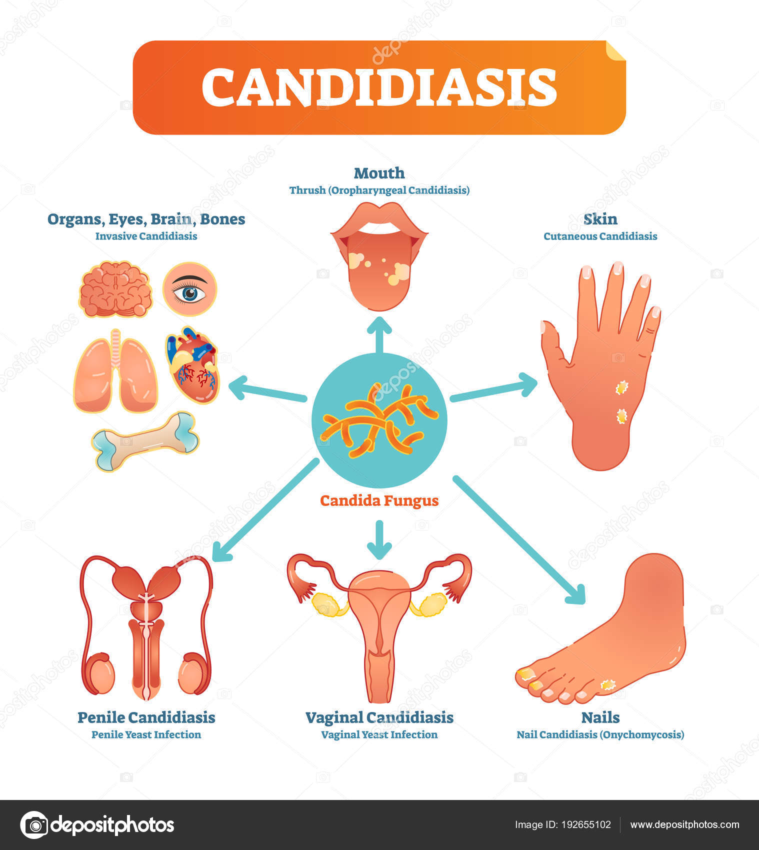 Candidiasis vector médico ilustración diagrama cartel con todo tipo de ...