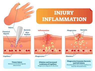 Yaralanma iltihap biyolojik insan vücudu yanıt vektör çizim düzeni. Yüzey yaralanma çapraz bölüm poster kılcal, fagositler ve trombosit cilt.