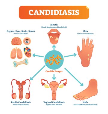 Candidiasis medical vector illustration diagram poster with all types of candida fungus on various human body parts and organs. clipart