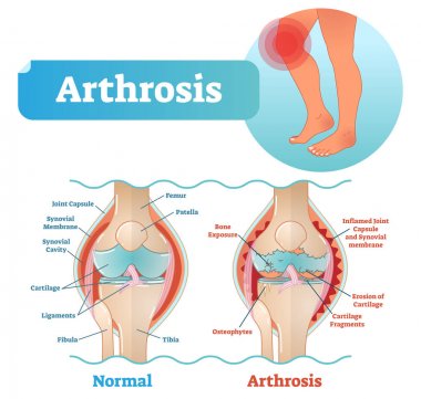 Arthrosis medical vector illustration diagram with damaged knee structure and healthy knee comparison. clipart