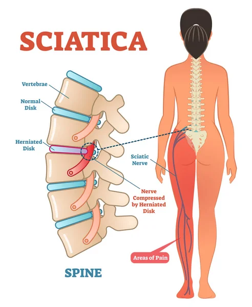 Sciatica medical health care vector illustration diagram scheme with lower spine and sciatic nerve pain in leg. — Stock Vector