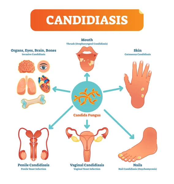 Candidiasis medicinsk vektor illustration diagram affisch med alla typer av candida svampen på olika mänskliga kroppsdelar och organ. — Stock vektor