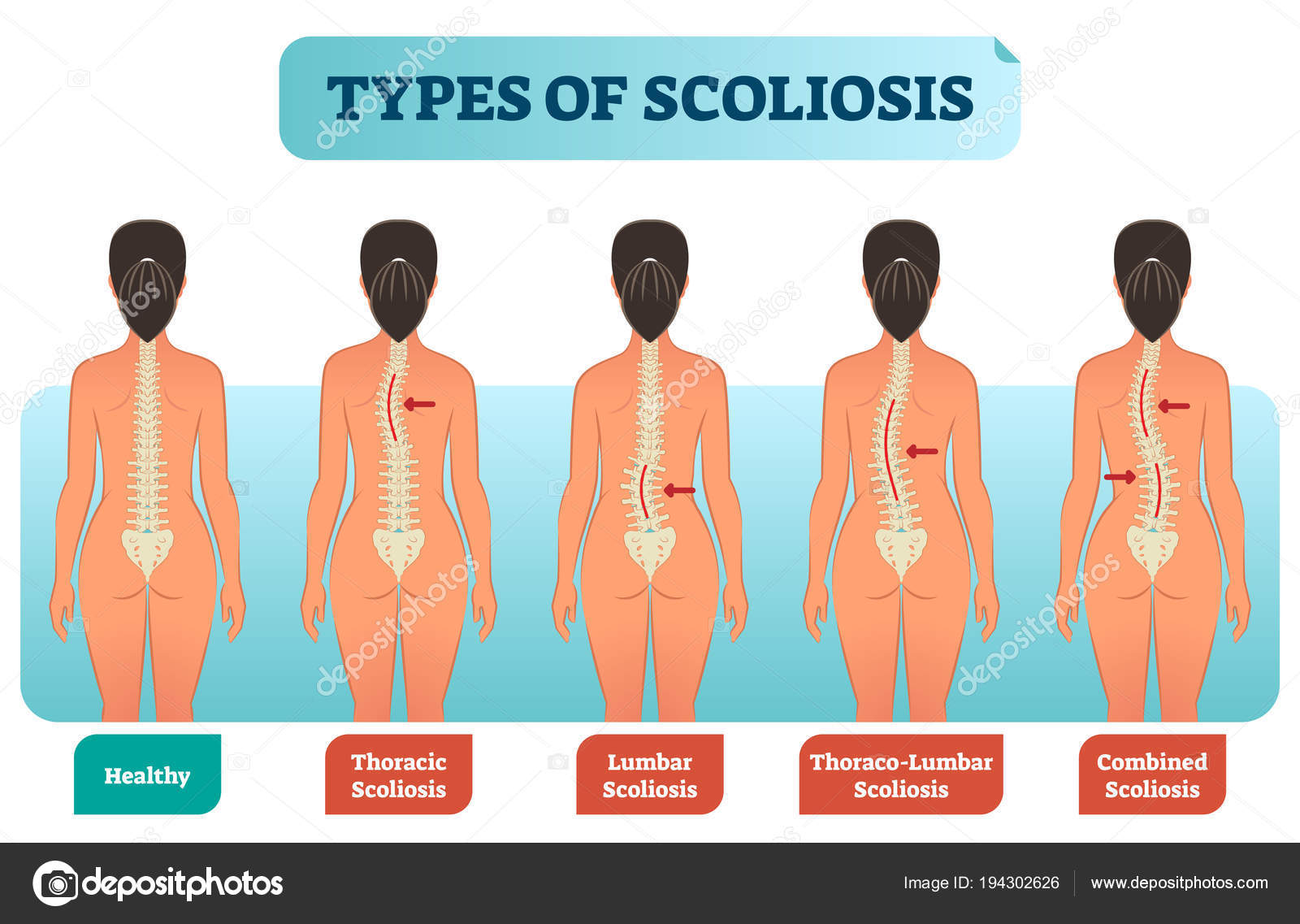 Types Of Scoliosis Medical Anatomical Vector Illustration Diagram With Spine Curvatures Stock Vector Image By C Vectormine 194302626