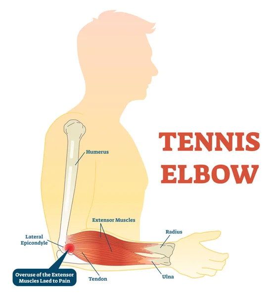 Schéma vectoriel d'illustration d'anatomie de forme physique médicale de coude de tennis avec des os de bras, des articulations et des muscles . — Image vectorielle