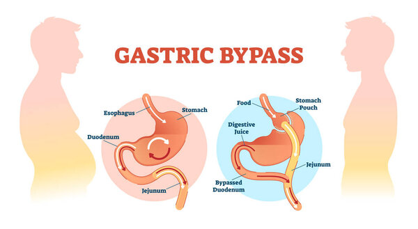 Gastric bypass medical surgery procedure vector illustration with esophagus, stomach, duodenum and jejunum flow.