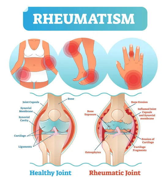 Rheuma Medical Health Care Vektor Illustration Posterdiagramm mit beschädigter Knieerosion und schmerzhaften Körpergelenken. — Stockvektor