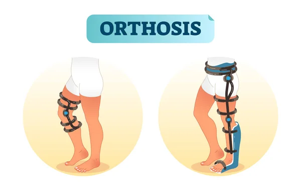 Ilustração de vetor de equipamento médico de órtese de perna humana . — Vetor de Stock