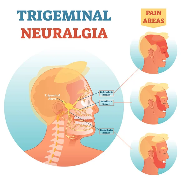 Trigeminus neuralgie medische doorsnede anatomie vector illustratie diagram met gezichts neuraal netwerk en pijn gebieden. — Stockvector