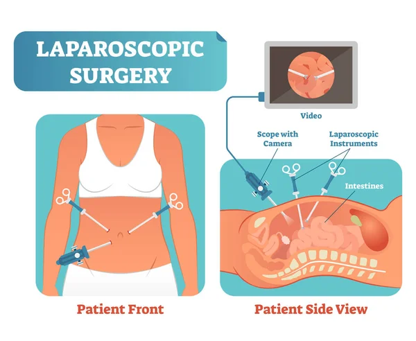 Laparoscopische chirurgie medische gezondheidszorg chirurgische procedure proces, anatomische dwarsdoorsnede vector illustratie diagram. — Stockvector