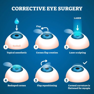 Corrective eye surgery vector illustration. Laser process education scheme. clipart