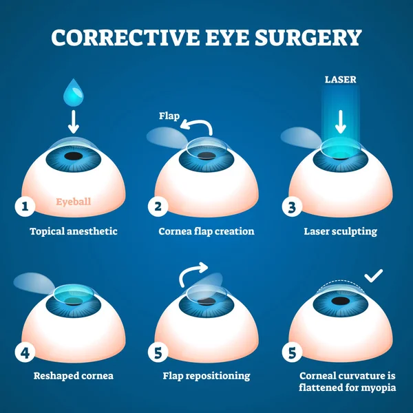 Корекційна хірургія ока Векторні ілюстрації. Схема навчання лазерного процесу . — стоковий вектор