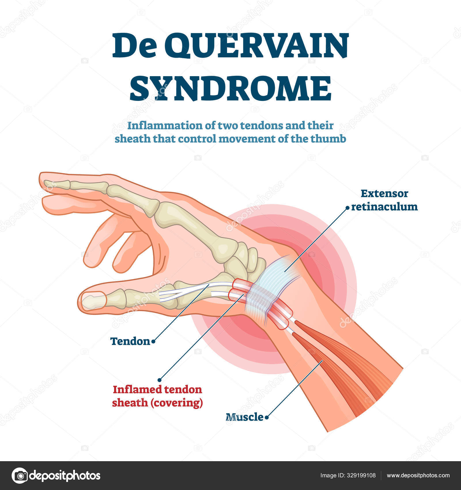 Ilustração vetorial da síndrome de De Quervain. Esquema de inflamação do  polegar rotulado Vetor de ©VectorMine 329199108, image size:1600x1700