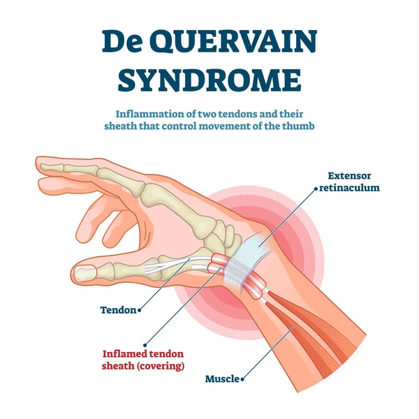 Ilustración vectorial del síndrome de Quervain. Esquema de inflamación del pulgar etiquetado — Archivo Imágenes Vectoriales