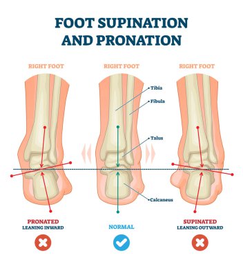 Foot supination and pronation vector illustration. Labeled medical scheme. clipart