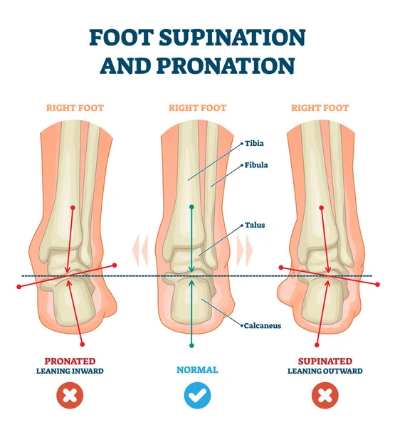 Foot supination and pronation vector illustration. Labeled medical scheme. — 스톡 벡터