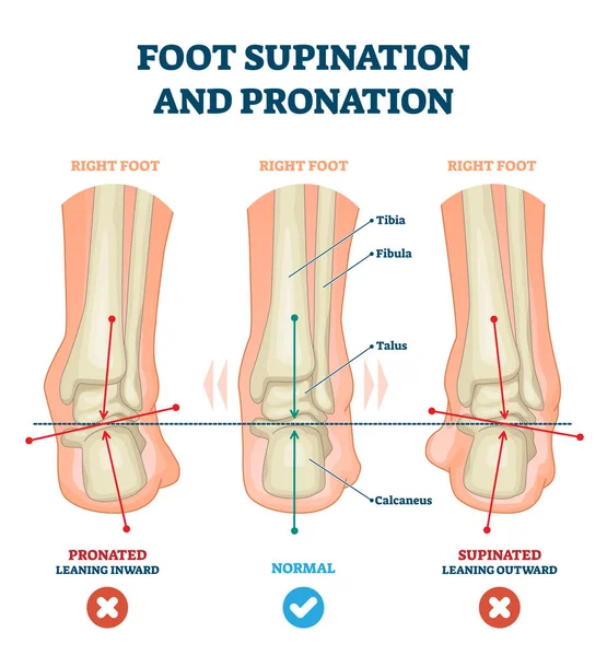 Supination des pieds et illustration vectorielle de pronation. Régime médical étiqueté . — Image vectorielle