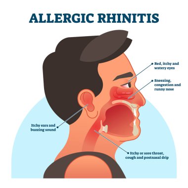 Alerjik rhinitis tıbbi diyagram, vektör illüstrasyon etiketli bilgi
